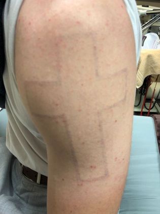 Tattoo Removal : Tattoo Removal 6 - After