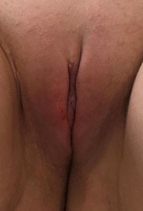 Labiaplasty Case 14 - Labiaplasty Norwalk - After