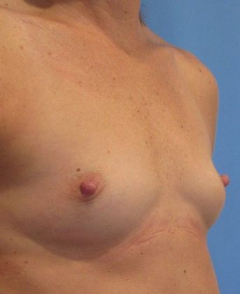 Breast Augmentation: Case 22 - Breast Augmentation New Milford - Before