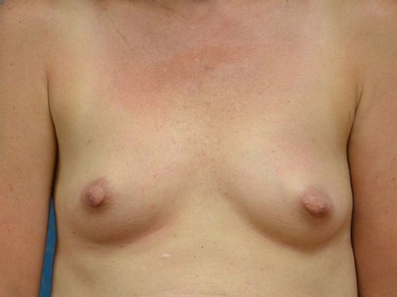 Breast Augmentation BA1320 - Fostoria, OH - Before