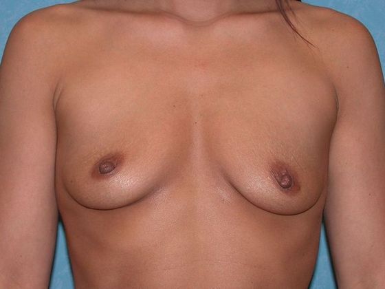 Breast Augmentation Case 1325- Perrysburg, OH - Before