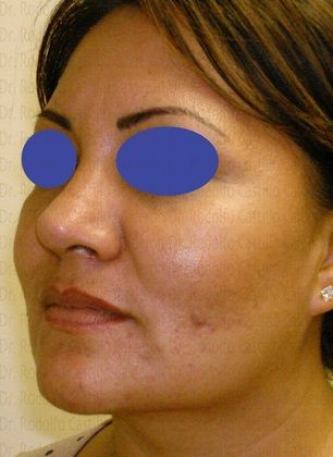 Bichatectomy (Cheek fat pad removal): Bichatectomy with neck lipo and rhinoplasty. - After