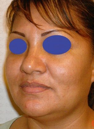 Bichatectomy (Cheek fat pad removal): Bichatectomy with neck lipo and rhinoplasty. - Before