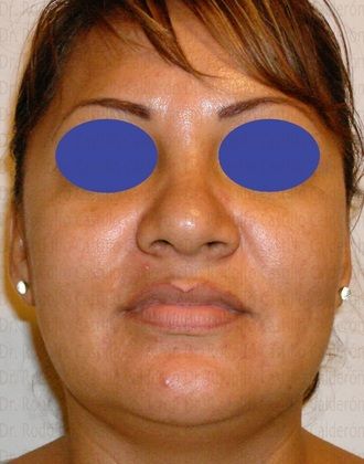 Bichatectomy (Cheek fat pad removal): Bichatectomy with neck lipo and rhinoplasty. - Before