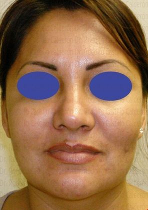 Bichatectomy (Cheek fat pad removal): Bichatectomy with neck lipo and rhinoplasty. - After