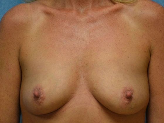 Breast Augmentation: Case 1329- Adrian, MI - Before