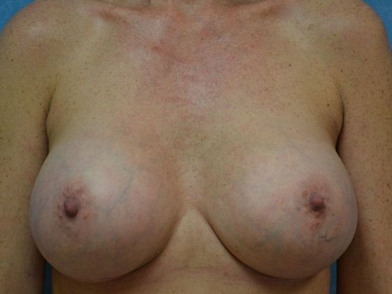 Breast Augmentation: Case 1329- Adrian, MI - After