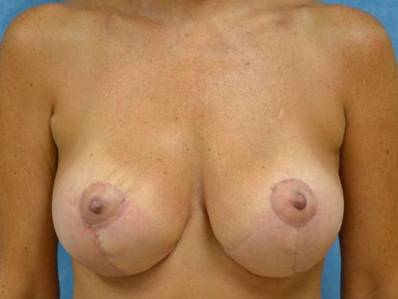 Breast Augmentation Case 1330- Arlington, OH - After