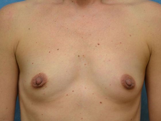 Breast Augmentation Case 1332- Maumee, OH - Before