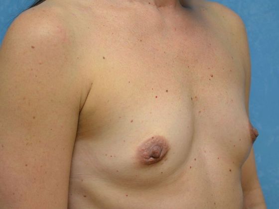 Breast Augmentation: Case 1332- Maumee, OH - Before