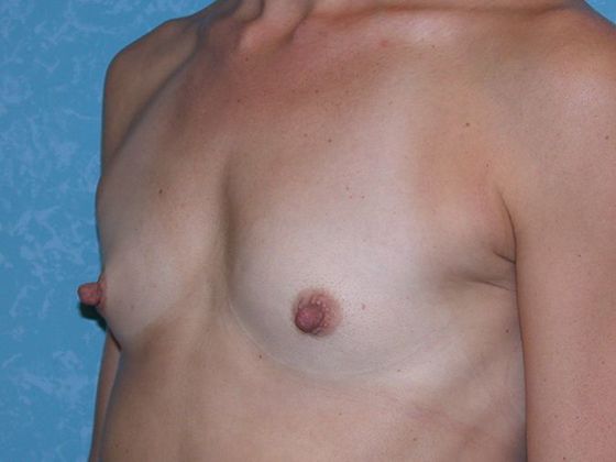 Breast Augmentation: Case 1333- Waterville, OH - Before