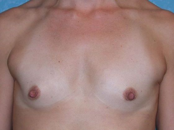 Breast Augmentation Case 1333- Waterville, OH - Before