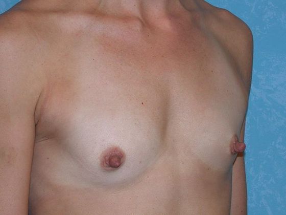 Breast Augmentation: Case 1333- Waterville, OH - Before