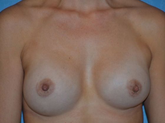 Breast Augmentation Case 1333- Waterville, OH - After