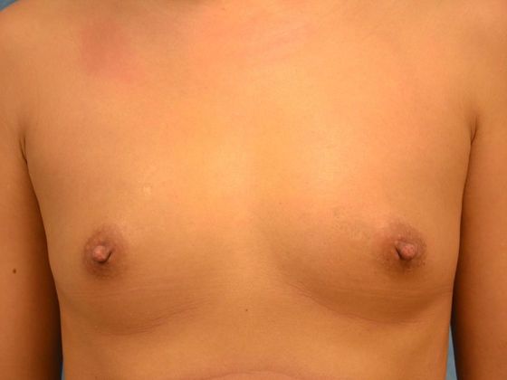 Breast Augmentation Case 1335- Toledo, OH - Before