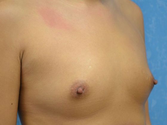 Breast Augmentation: Case 1335- Toledo, OH - Before