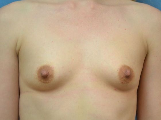 Breast Augmentation Case 1336- Toledo, OH - Before