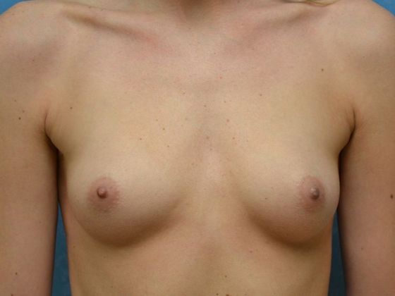 Breast Augmentation Case 1337- Perrysburg, OH - Before