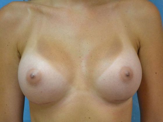 Breast Augmentation Case 1337- Perrysburg, OH - After