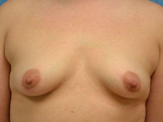 Breast Augmentation Case 1339- Millbury, OH - Before