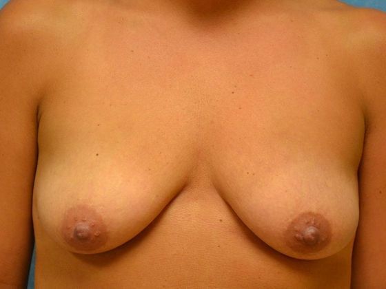 Breast Augmentation Case 1356- Fostoria, OH - Before