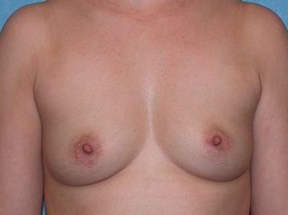 Breast Augmentation BA1314 - Oregon, OH - Before