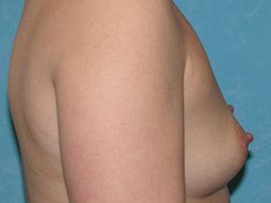 Breast Augmentation: BA1314 - Oregon, OH - Before