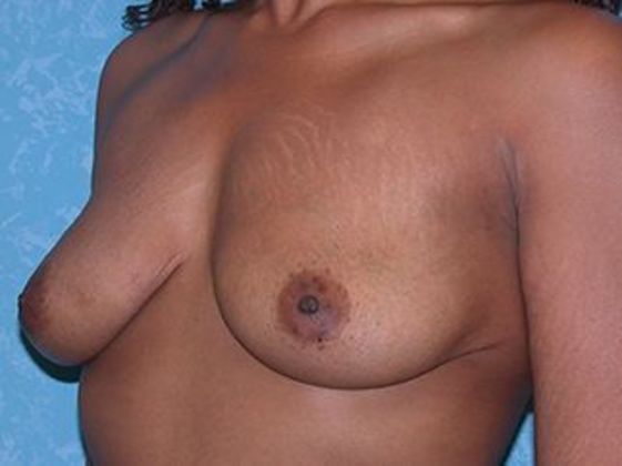 Breast Augmentation: BA1315 - Maumee, OH - Before