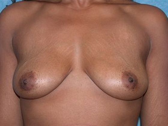 Breast Augmentation BA1315 - Maumee, OH - Before