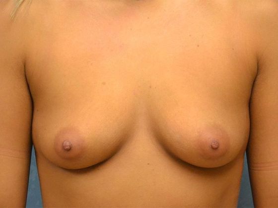 Breast Augmentation BA1318 - Toledo, OH - Before