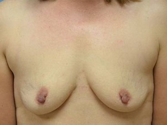 Breast Augmentation BA1327 - Toledo, OH - Before