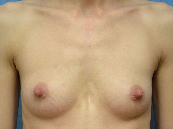 Breast Augmentation BA1343 - Perrysburg, OH - Before