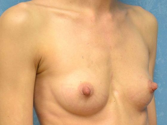 Breast Augmentation: BA1343 - Perrysburg, OH - Before