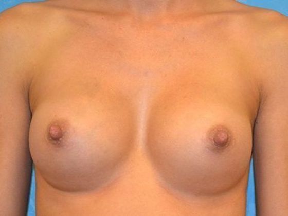 Breast Augmentation BA1343 - Perrysburg, OH - After