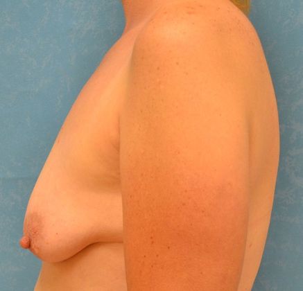 Breast Augmentation: BA1357 - Perrysburg, OH - Before