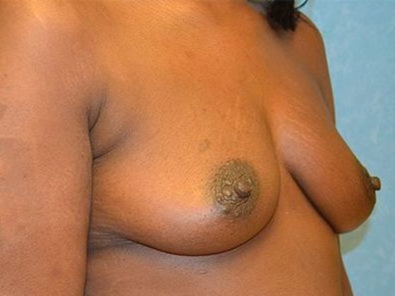 Breast Augmentation: Case 1319 -Toledo, OH - Before