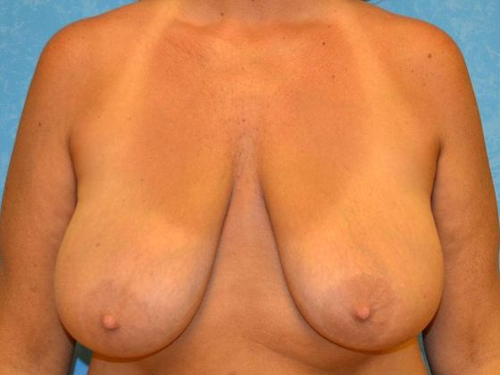 Breast Lift: BL1209 -Perrysburg, OH - Before