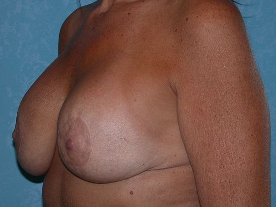 Breast Lift: BL1209 -Perrysburg, OH - After