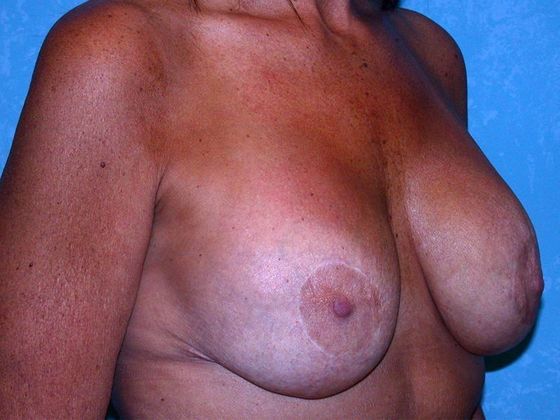 Breast Lift: BL1209 -Perrysburg, OH - After