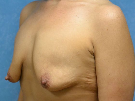 Breast Lift: Case 1426- Newport, MI - Before