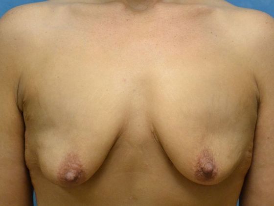 Breast Lift Case 1426- Newport, MI - Before