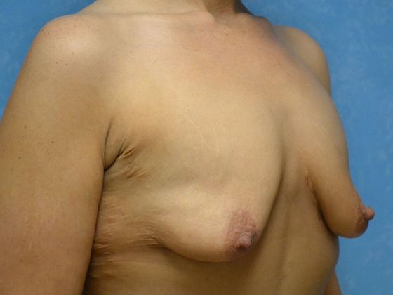 Breast Lift: Case 1426- Newport, MI - Before
