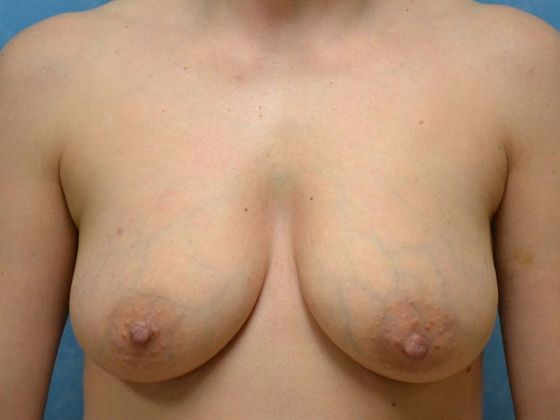 Breast Lift Case 1429- Fostoria, OH - Before