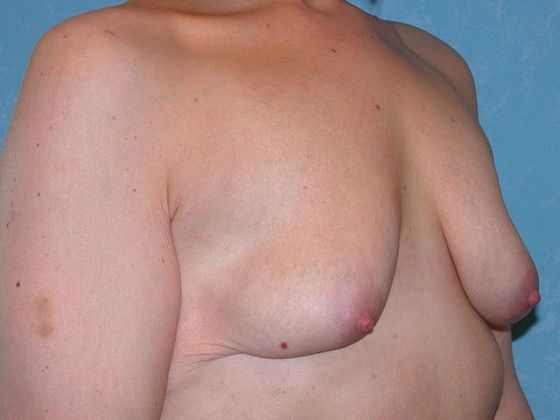 Breast Lift Case 1430- Van Wert, OH - Before