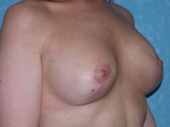 Breast Lift Case 1430- Van Wert, OH - After