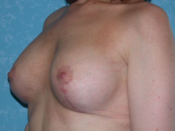 Breast Lift: Case 1430- Van Wert, OH - After