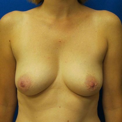 Implant Breast Reconstruction Case 22 - Before