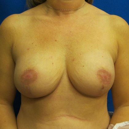 Implant Breast Reconstruction Case 25 - After
