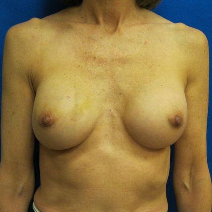Implant Breast Reconstruction Case 27 - Before