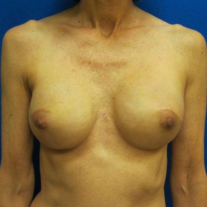 Implant Breast Reconstruction Case 27 - After